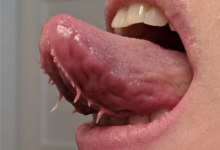 男子舌头天生异常：下面竟然长着两条“流苏”！-紫竹林-程序员中文网