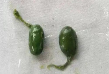 女子生吞鱼胆降火导致肝衰竭 医生：毒性堪比砒霜 无解药-紫竹林-程序员中文网