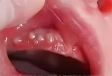 消毒险酿致命错!2个月宝宝被奶奶擦碘伏进ICU-紫竹林-程序员中文网