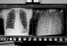 “人工肺”实现48小时无肺生存-紫竹林-程序员中文网