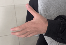 高中生左手莫名发抖半年确诊平山病：长期保持错误坐姿-紫竹林-程序员中文网